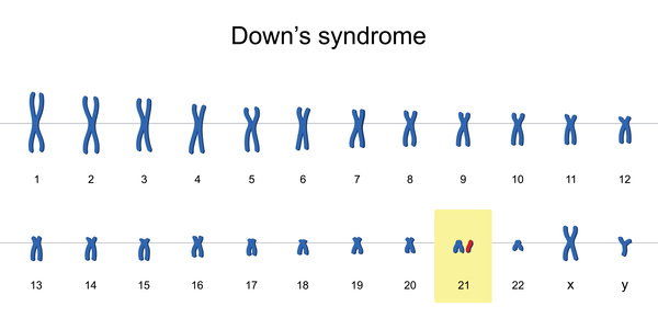 ダウン症の染色体