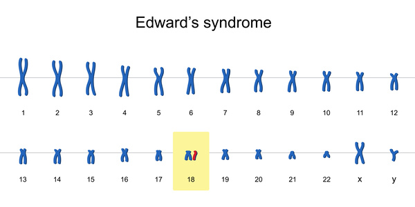 18トリソミーの染色体
