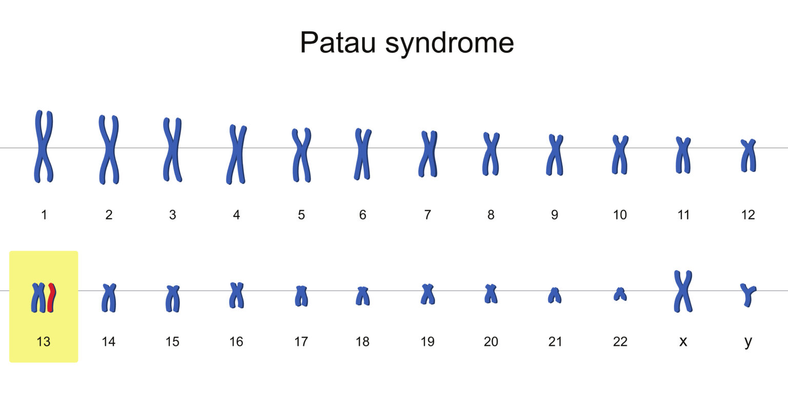 13トリソミーの染色体