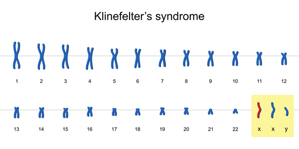 クラインフェルター症候群の染色体