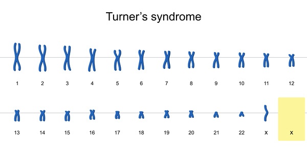 ターナー症候群の染色体