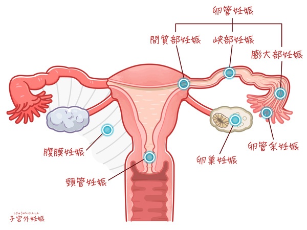 子宮外妊娠、異所性妊娠