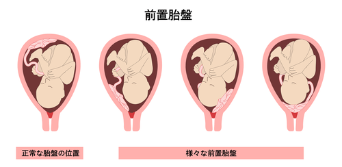 前置胎盤