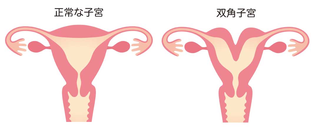 正常な子宮と双角子宮