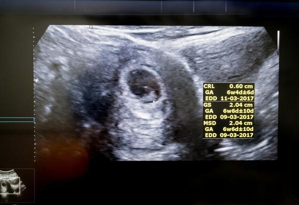 妊娠6週目の超音波画像