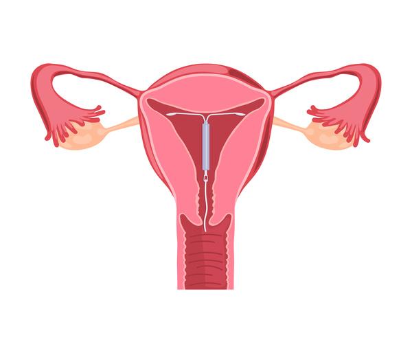 子宮内避妊器具（IUD）