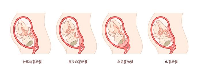 色々な種類の前置胎盤