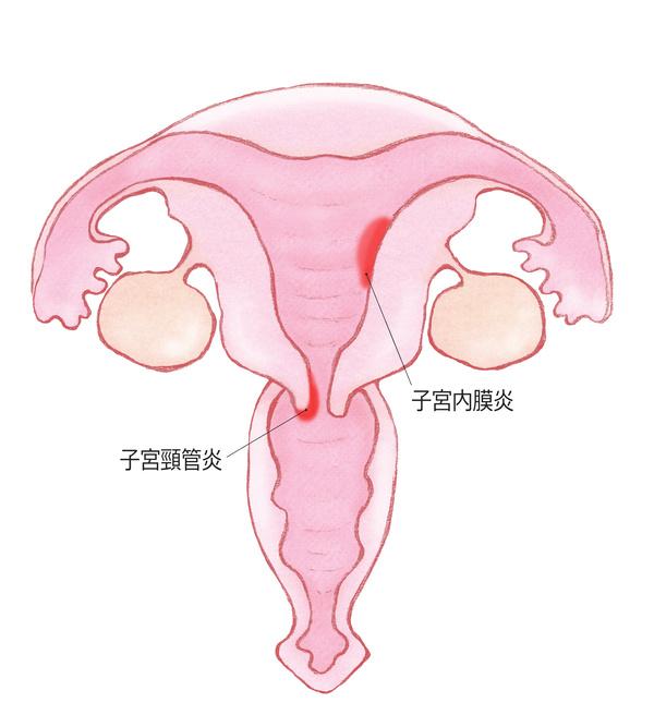 子宮内膜炎、子宮頸管炎