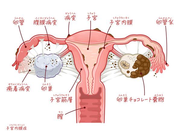 子宮内膜症の子宮のイラスト