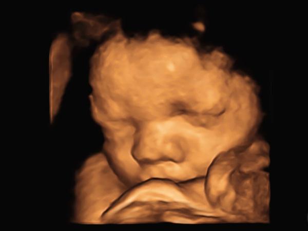胎児ドックの画像