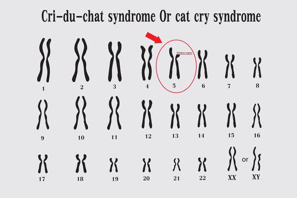 猫鳴き症候群の染色体