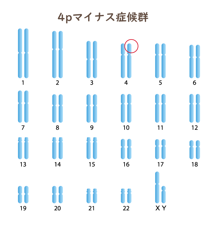 4pマイナス症候群の染色体